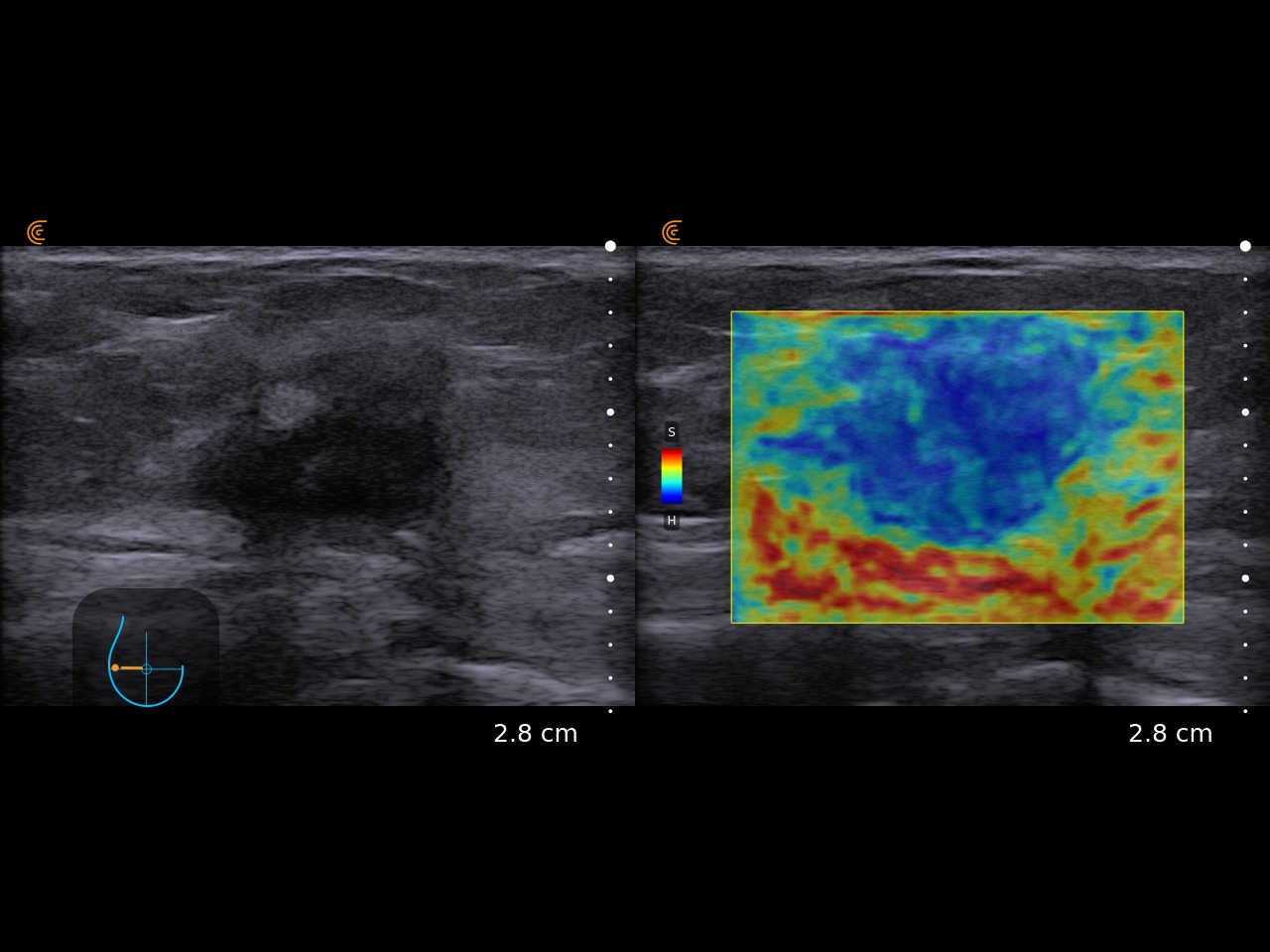 Clarius L15 - Carcinoma mamario con elastografía HD3